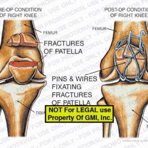 The exhibit illustrates pre-op and post-op conditions of the right knee showing fractures of patella, femur, tibia, and pins and wires fixating fractures of patella.
