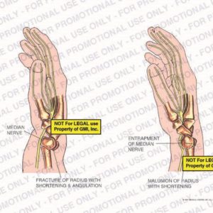 The exhibit illustrates the pre-op condition of the right hand showing median nerve, fracture of radius with shortening and angulation, entrapment of median nerve, and malunion of radius with shortening.