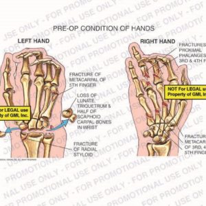 The exhibit illustrates the pre-op condition of both hands showing fracture of metacarpal of the 5th finger of the left hand, loss of lunate, triquetrum, and half of scaphoid carpal bones in the wrist, fracture of radial styloid, fractures of proximal phalanges and metacarpals of 3rd, 4th, and 5th fingers of the right hand.