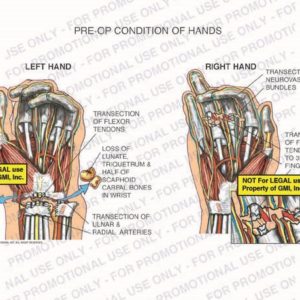The exhibit illustrates the pre-op condition of both hands showing transection of flexor tendons, loss of lunate triquetrum and half of scaphoid carpal bones in wrist, transection of ulnar and radial arteries, transection of neurovascular bundles, and transection of flexor tendons to 3rd and 4th fingers.