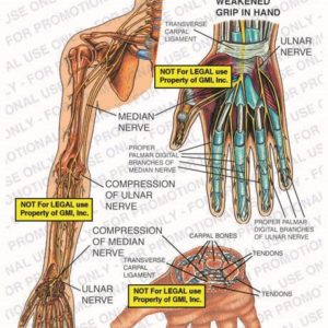 The exhibit illustrates the pre-op condition of the right arm and hand showing the transverse carpal ligament, median nerve, compression of ulnar and median nerves, numbness of fingers, carpal bones, tendons, proper palmar digital branches of the median and ulnar nerves, and weakened grip in hand.