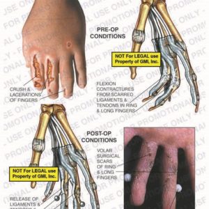 The exhibit illustrates pre-op and post-op injuries of the left hand showing crush and lacerations of fingers, flexion contractures from scarred ligaments and tendons in the ring and long fingers, release of ligaments and tendons and pinning of the ring and long fingers, and volar surgical scars of the ring and long fingers.