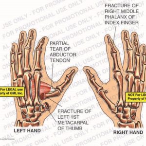 The exhibit illustrates the pre-op condition of both hands showing partial tear of abductor tendon, fracture of left 1st metacarpal of thumb, and fracture of right middle phalanx of index finger.