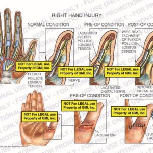 The exhibit illustrates the normal condition of a right hand versus the pre-op and post-op conditions of a right hand injury showing flexor pollicis longus tendon, digital nerve, lacerated flexor pollicis longus tendon, lacerated digital nerve, wire reattachment of flexor pollicis longus tendon, button, laceration, and sutured laceration.