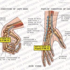 The exhibit illustrates the pre-op and post-op conditions of the left hand, with side views, showing wrist flexion contracture, flexion contractures of 3rd, 4th. and 5th digits, flexion contracture and interphalangeal instability of thumb, fusion of wrist with plate and screws in 10-20° dorsiflexion, drilled out joint surfaces in wrist, lengthening of transection of flexor tendons, interphalangeal fixation of thumb, and extension of digits.