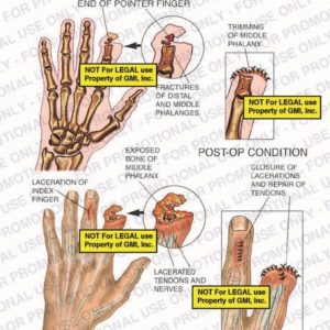 The exhibit illustrates the amputation and post-op condition of the pointer finger showing the amputation of end of pointer finger, fractures of distal and middle phalanges, trimming of middle phalanx, laceration of index finger, exposed bone of middle phalanx, lacerated tendons and nerves, and closure of lacerations and repair of tendons.