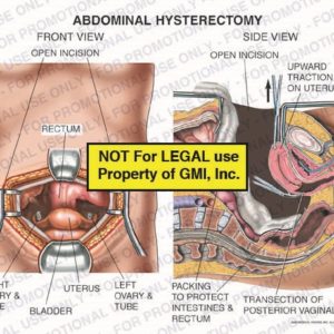 The exhibit illustrates an abdominal hysterectomy, with front and side views, showing an open incision, rectum, right ovary and tube, bladder, uterus, left ovary and tube, upward traction of the uterus, packing to protect intestines and rectum, and transection of posterior vaginal wall.