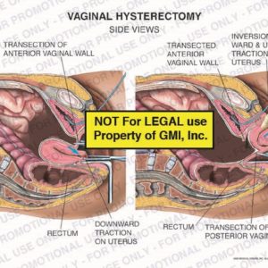 The exhibit illustrates a vaginal hysterectomy, with side views, showing transection of the anterior vaginal wall, downward traction on the uterus, transected anterior vaginal wall. inversion, outward and upward traction of the uterus, rectum, and transection of posterior vaginal wall.